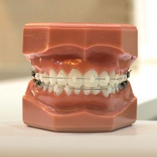 Braces orthodontics (1)-min
