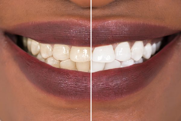 teeth-whitening-header-1