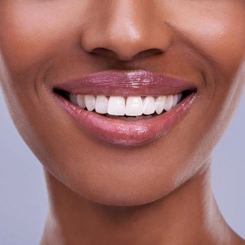teeth whitening-min